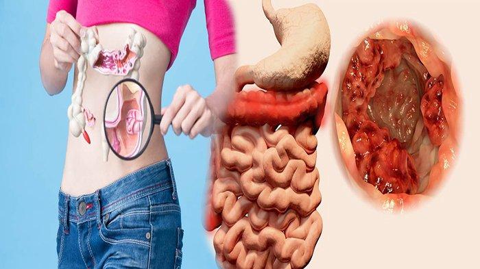 Kanker Usus Kini Mengincar Usia Muda