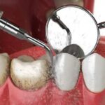 Kapan Scaling Gigi Ditanggung BPJS? Ini Penjelasan Lengkap dan Hangat untuk Peserta JKN