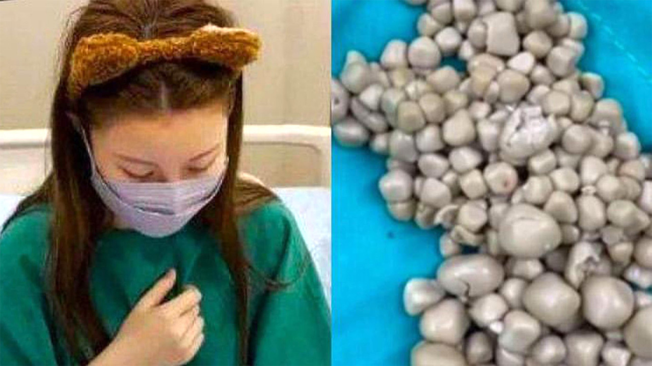 Ginjal Wanita 26 Tahun Kolaps Akibat Minum Boba Tiap Hari, Ini Bahaya yang Mengintai